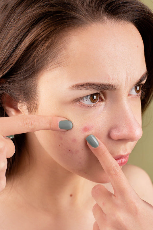 Hormonal Acne: Your Period Isn't the Enemy
