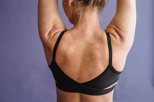 Body Acne: Why Your Back Keeps Breaking Out