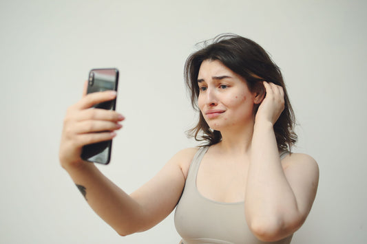 Clear Skin Isn't Perfect Skin: Reframing Acne