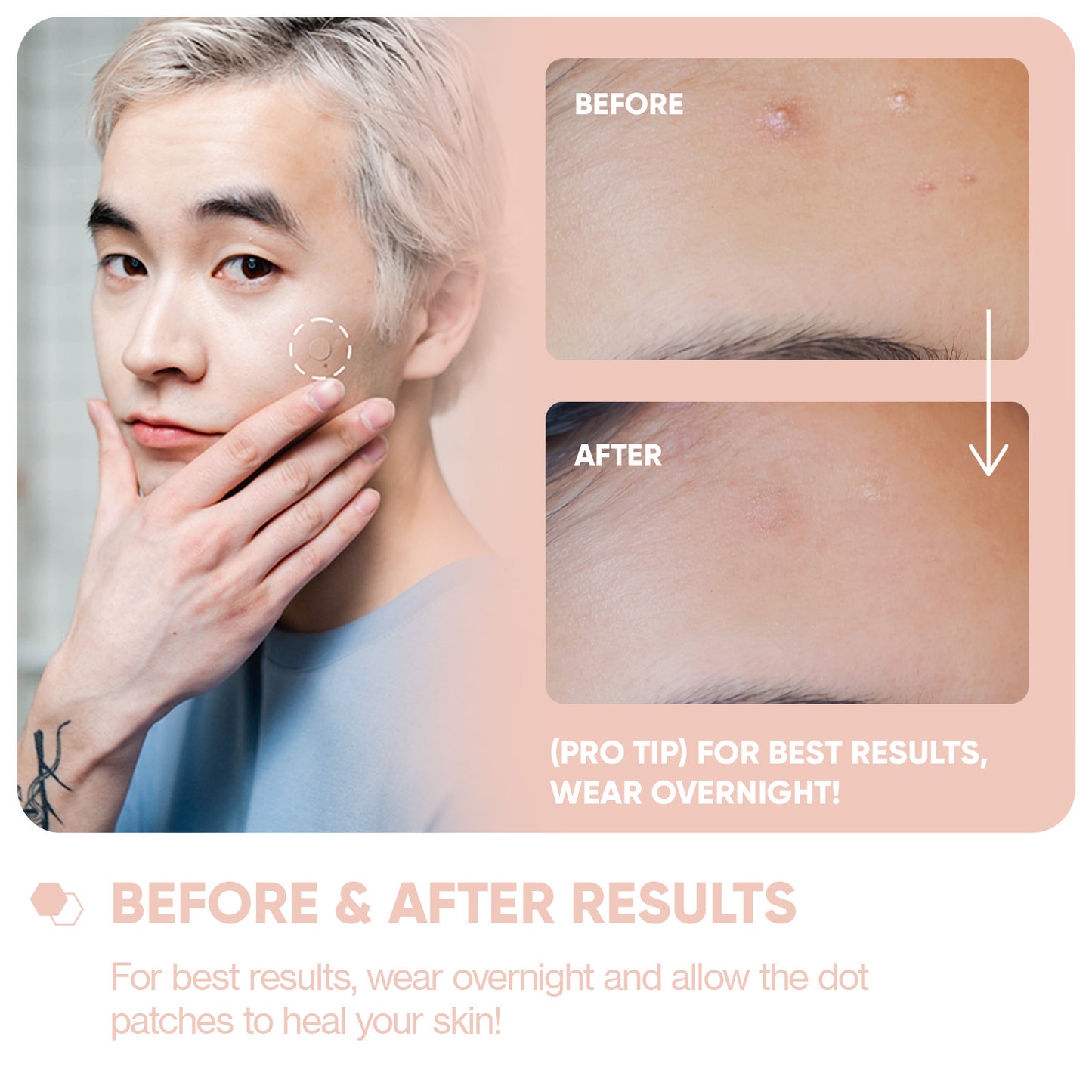 Emergency Dots for spots and blemishes with Salicylic Acid