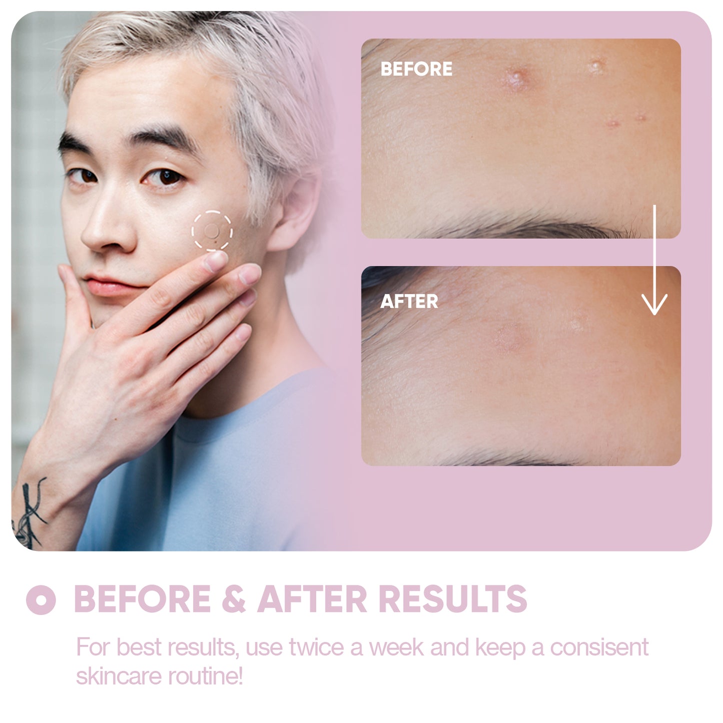 Micro Needle Patches for Dark Spots
