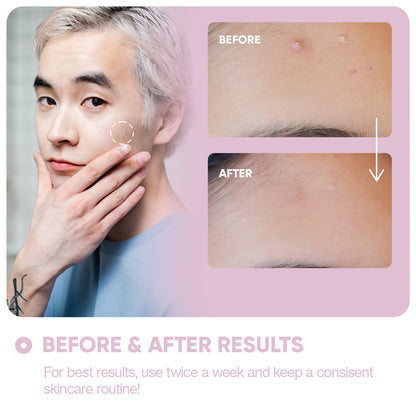 Micro Needle Patches for Dark Spots